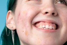 Photo of From Repairing Moisturizer to Acne Dots: Your Complete Breakout-Busting Skincare Routine