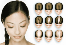 Photo of Male and Female Pattern Baldness: Causes, Diagnoses, and Treatments