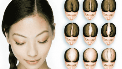 Photo of Male and Female Pattern Baldness: Causes, Diagnoses, and Treatments