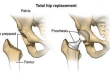 Photo of Best Hip Rеplacеmеnt in Jaipur – Joints Pro Clinic