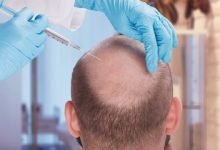 Photo of How FUE Hair Transplant Is Better than Home Remedies