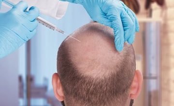 Photo of How FUE Hair Transplant Is Better than Home Remedies