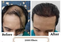 Photo of Looking for Synthetic Hair Transplant Surgery or Bio-Fibre Hair Transplant