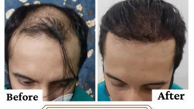 Photo of Looking for Synthetic Hair Transplant Surgery or Bio-Fibre Hair Transplant