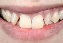Photo of 7 Reasons To Consider Dental Implants to Replace Your Missing Teeth