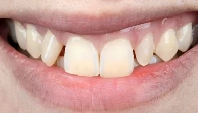 Photo of 7 Reasons To Consider Dental Implants to Replace Your Missing Teeth