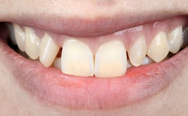 Photo of 7 Reasons To Consider Dental Implants to Replace Your Missing Teeth