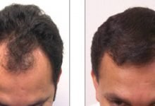 Photo of Know What The Hair Transplant FUE Cost Is?
