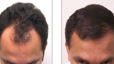 Photo of Know What The Hair Transplant FUE Cost Is?