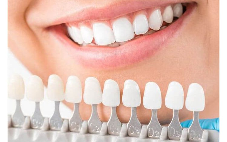Teeth Whitening for Crowns