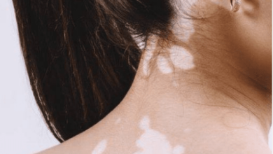Photo of How Different Is The Ayurvedic Treatment For Leucoderma From Allopathy?