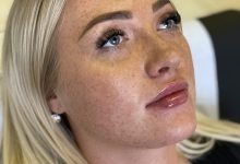 Photo of How Long Do You Need to Use Botox?