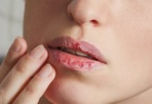 Photo of Antifungal Cream For Lips Protects Your Lips Throughout The Year!
