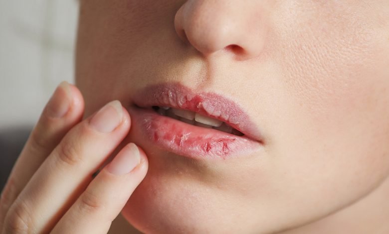 antifungal cream for lips