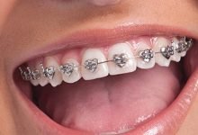 Photo of Does braces change face shape?