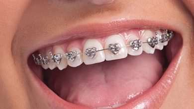 Photo of Does braces change face shape?