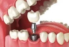 Photo of The Benefits of Implant Dental