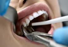 Photo of Is My Tooth Infection Spreading?