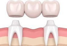 Photo of Why Cantilever Bridge Dentistry is the Best Option for Your Dental Health
