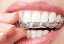 Photo of How Much Does It Cost To Get A New Retainer?