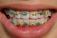 Photo of Braces and the Coloring Wheel