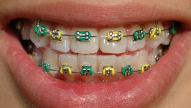 Photo of Braces and the Coloring Wheel