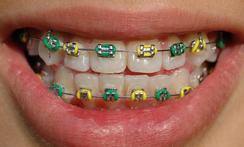 Photo of Braces and the Coloring Wheel