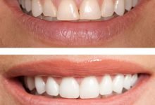 Photo of Composite Bonding Before and After Pictures
