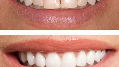 Photo of Composite Bonding Before and After Pictures