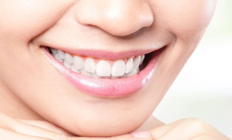You Need to Know These Things Before Getting Your Teeth Professionally Whitened