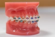 Photo of The Dangers Of Braces and Power Chains
