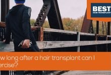 Photo of How long after a hair transplant can I exercise?
