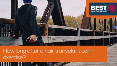 Photo of How long after a hair transplant can I exercise?