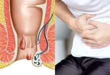 Photo of Minimally Invasive Procedures: Piles Treatment