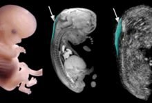 Photo of Our Nuchal Translucency screening program