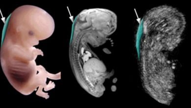 Photo of Our Nuchal Translucency screening program