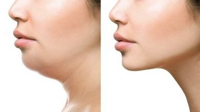 Photo of Guide of Surgical and Non-Surgical Double Chin Removal Treatment