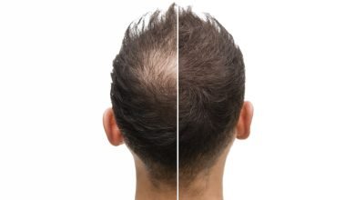 Photo of How to Find the Perfect Scalp Micropigmentation Cost in Palm Desert