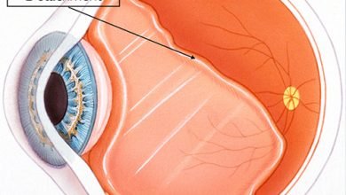 Photo of What is Posterior vitreous detachment?