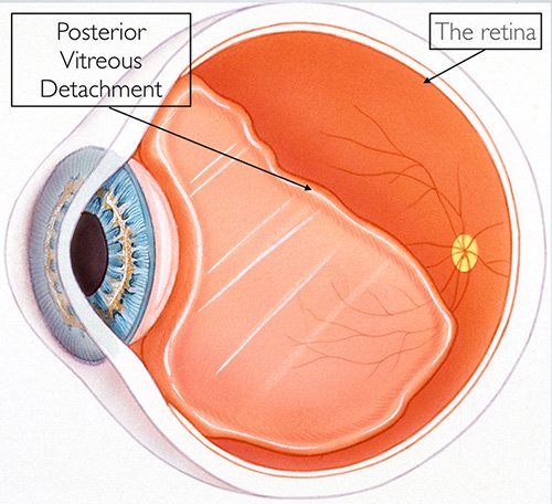 Photo of What is Posterior vitreous detachment?